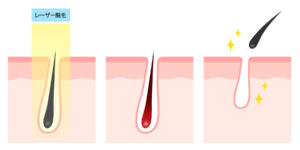 医療脱毛のレーザー照射で毛が無くなる仕組み